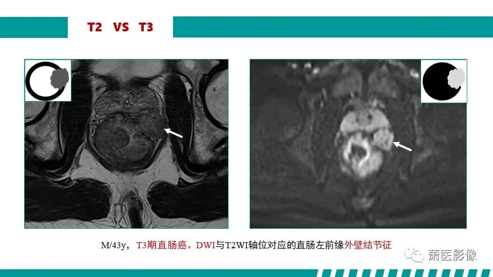 影像PPT - 【PPT】直肠癌影像学评价-42