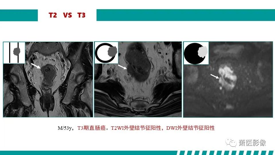 影像PPT - 【PPT】直肠癌影像学评价-43