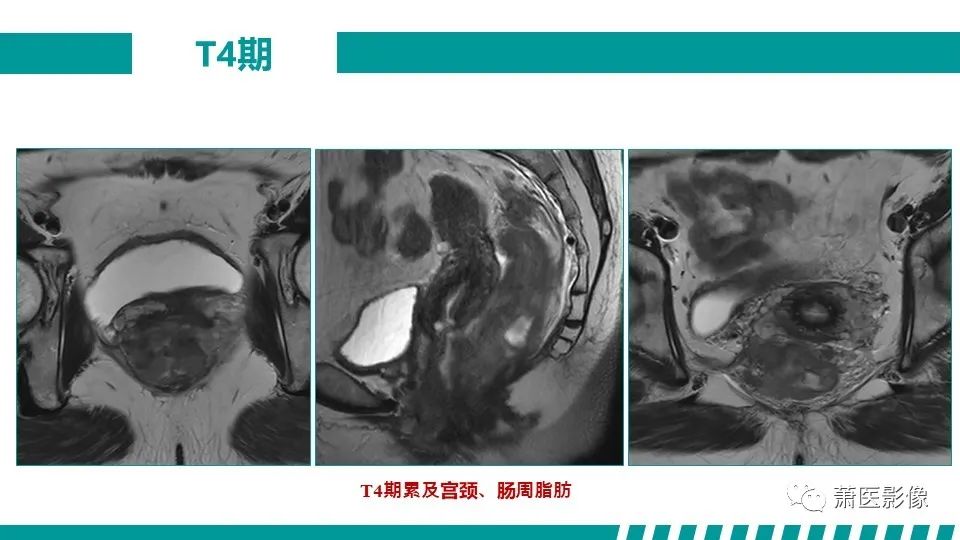影像PPT - 【PPT】直肠癌影像学评价-44