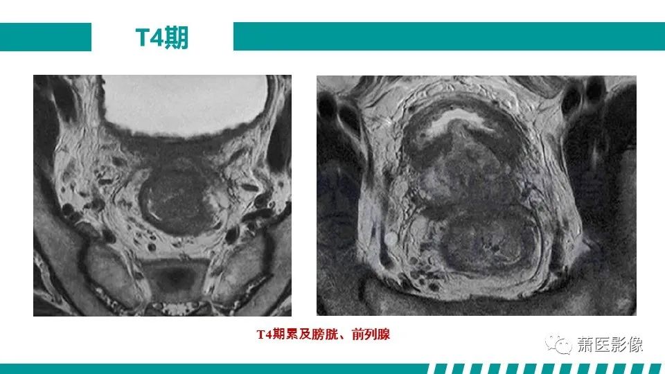 影像PPT - 【PPT】直肠癌影像学评价-45