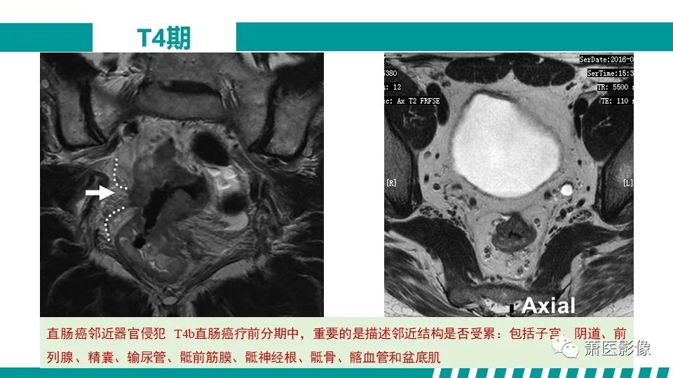 影像PPT - 【PPT】直肠癌影像学评价-46