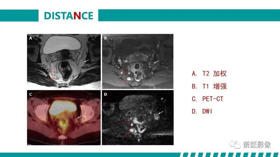 影像PPT - 【PPT】直肠癌影像学评价-50