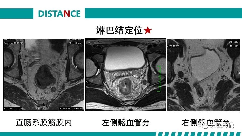 影像PPT - 【PPT】直肠癌影像学评价-51
