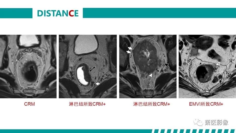 影像PPT - 【PPT】直肠癌影像学评价-55