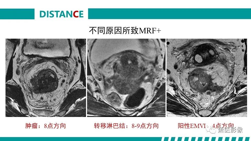 影像PPT - 【PPT】直肠癌影像学评价-56
