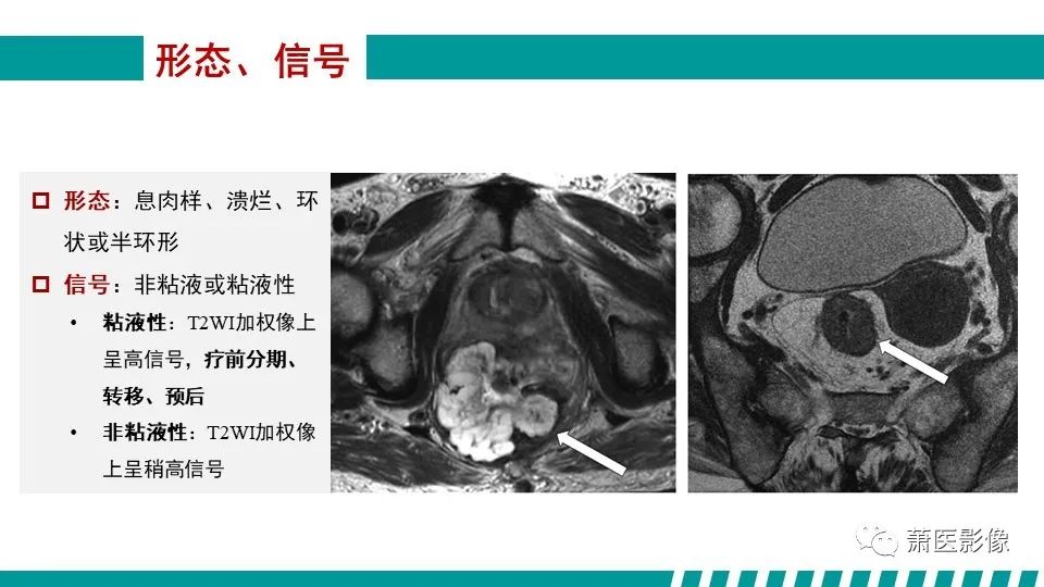 影像PPT - 【PPT】直肠癌影像学评价-61