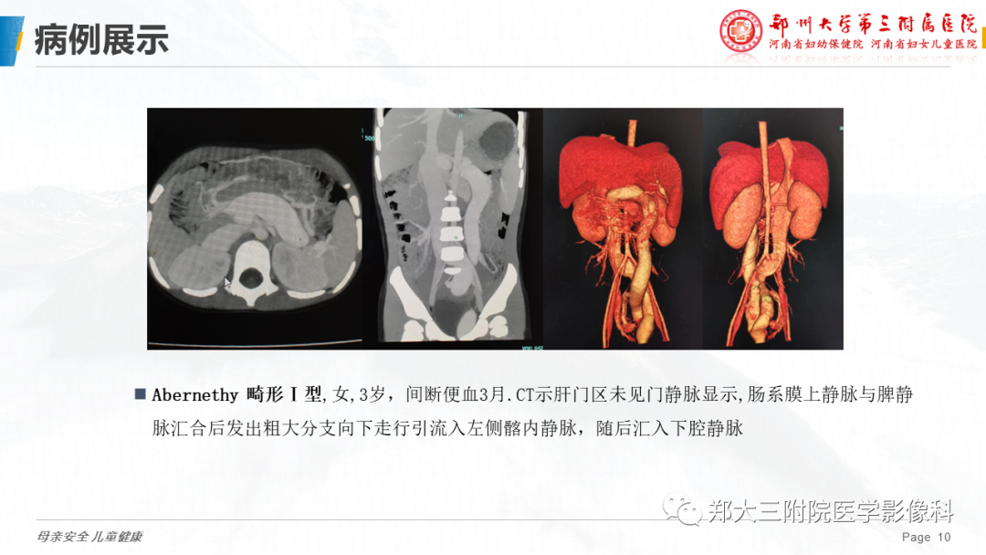 影像PPT - 【PPT】先天性门体静脉分流-10