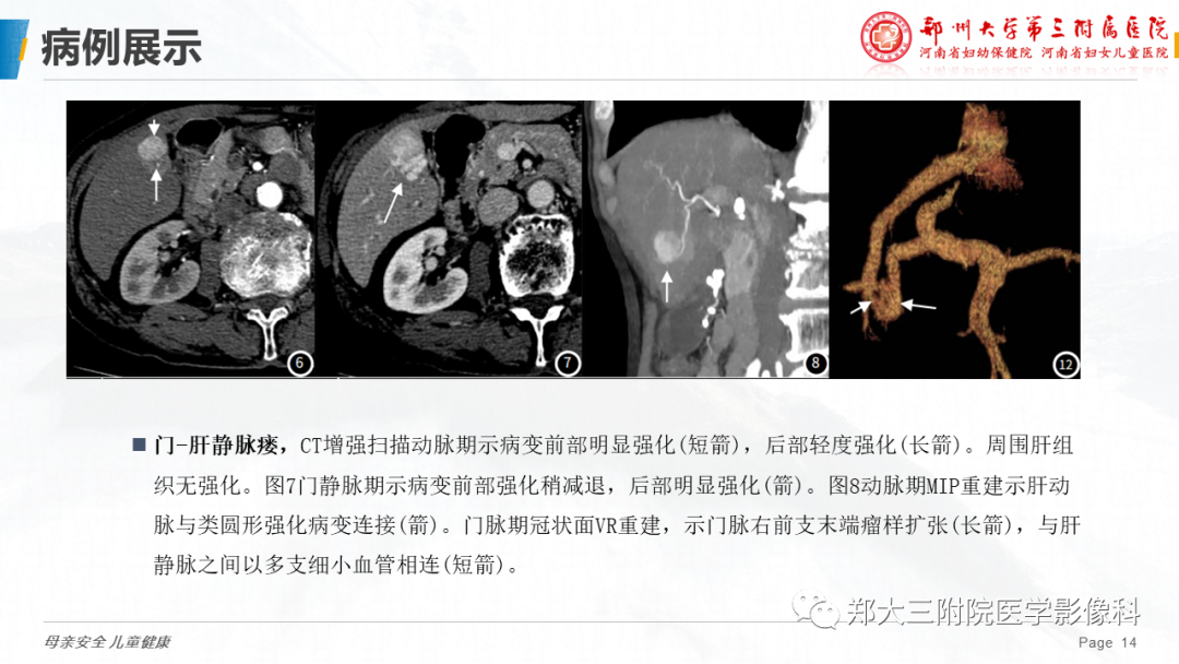 影像PPT - 【PPT】先天性门体静脉分流-14