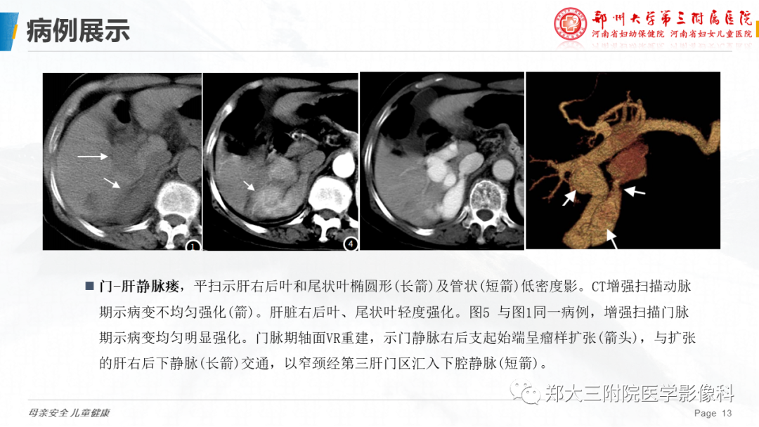 影像PPT - 【PPT】先天性门体静脉分流-13