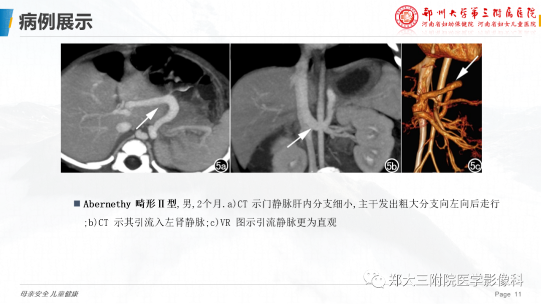 影像PPT - 【PPT】先天性门体静脉分流-11
