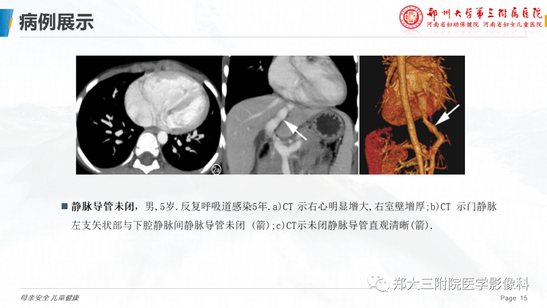 影像PPT - 【PPT】先天性门体静脉分流-15