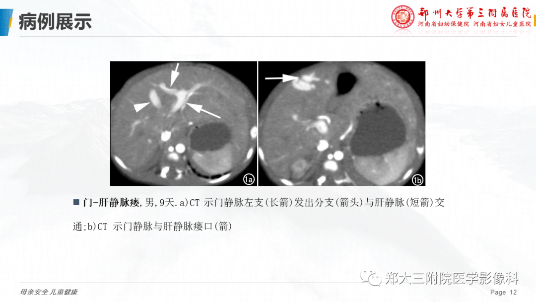 影像PPT - 【PPT】先天性门体静脉分流-12