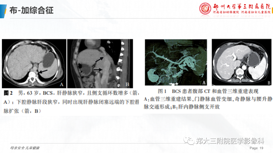 影像PPT - 【PPT】先天性门体静脉分流-19