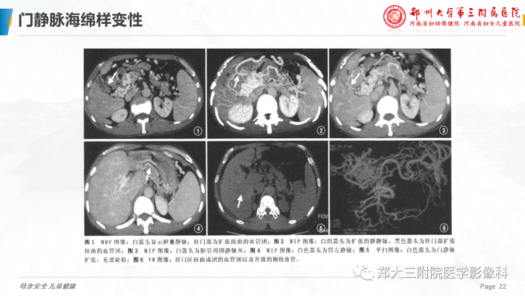 影像PPT - 【PPT】先天性门体静脉分流-22
