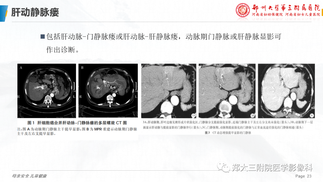 影像PPT - 【PPT】先天性门体静脉分流-23