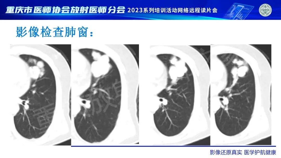 影像PPT - 【病例】肺大细胞神经内分泌癌1例CT影像-4