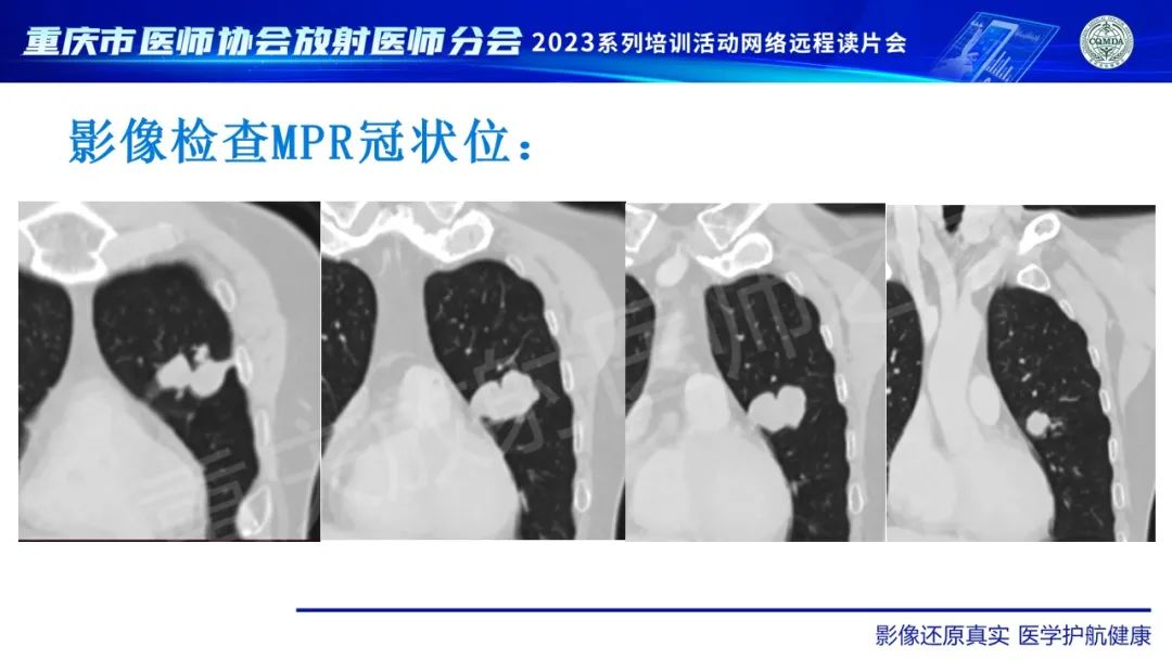 影像PPT - 【病例】肺大细胞神经内分泌癌1例CT影像-5