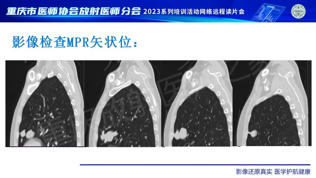 影像PPT - 【病例】肺大细胞神经内分泌癌1例CT影像-6