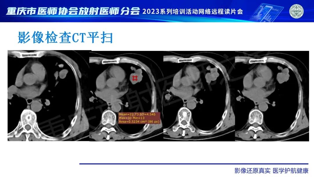 影像PPT - 【病例】肺大细胞神经内分泌癌1例CT影像-7
