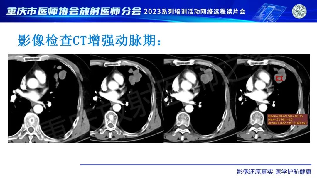 影像PPT - 【病例】肺大细胞神经内分泌癌1例CT影像-8