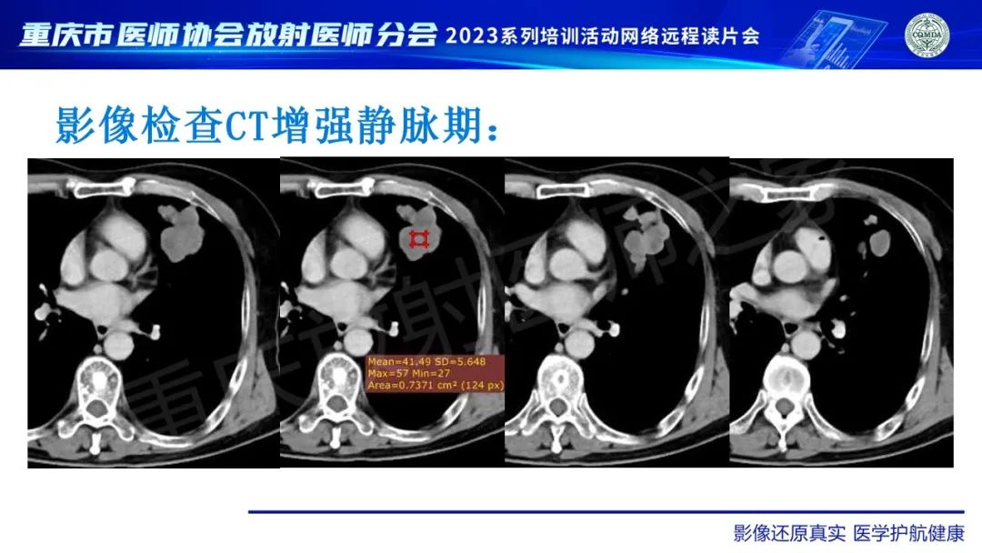 影像PPT - 【病例】肺大细胞神经内分泌癌1例CT影像-9