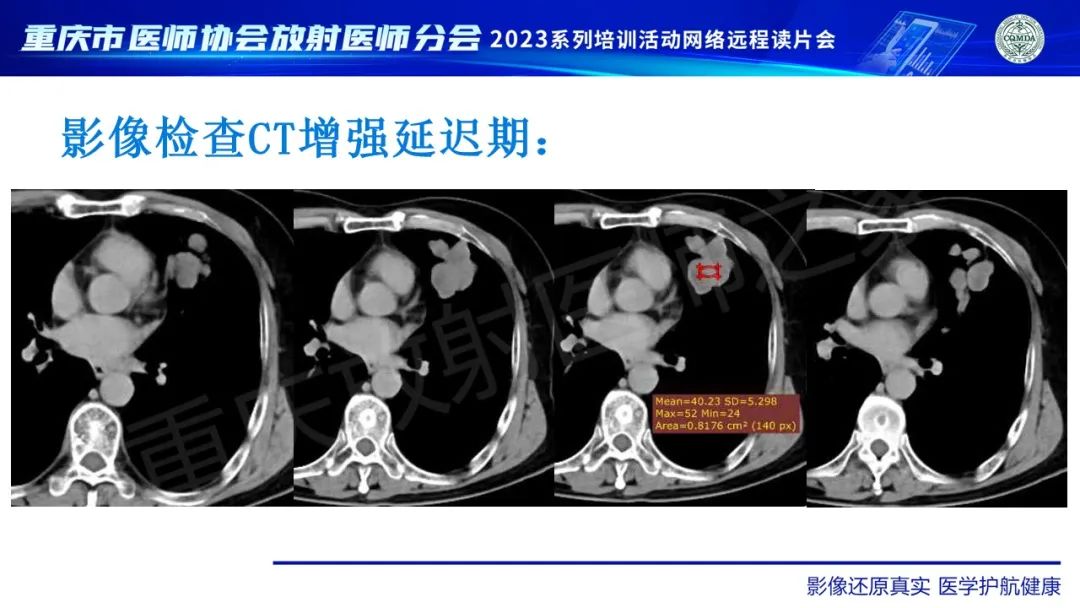 影像PPT - 【病例】肺大细胞神经内分泌癌1例CT影像-10