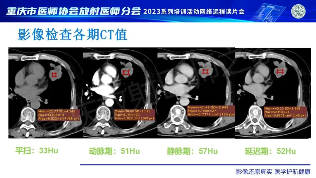 影像PPT - 【病例】肺大细胞神经内分泌癌1例CT影像-11