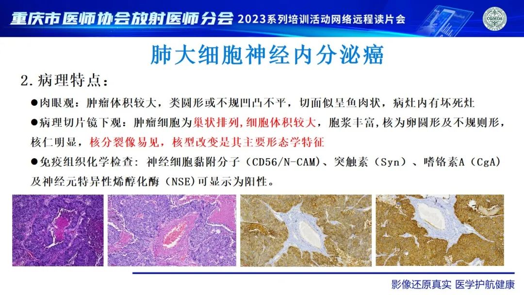 影像PPT - 【病例】肺大细胞神经内分泌癌1例CT影像-17