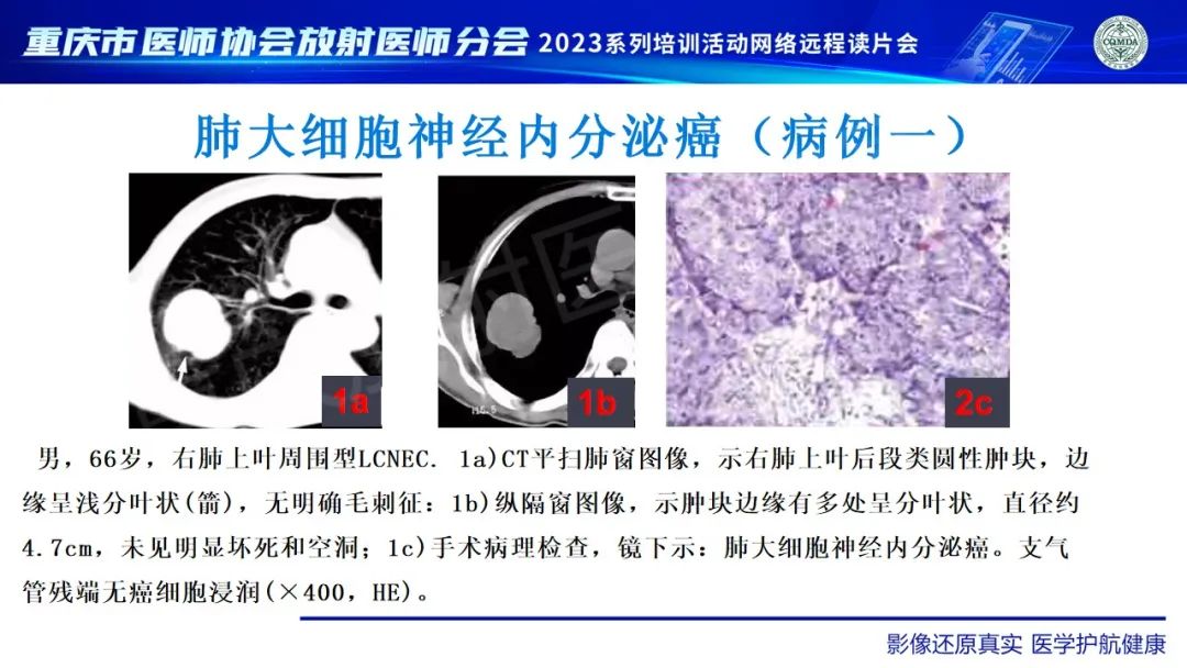 影像PPT - 【病例】肺大细胞神经内分泌癌1例CT影像-26