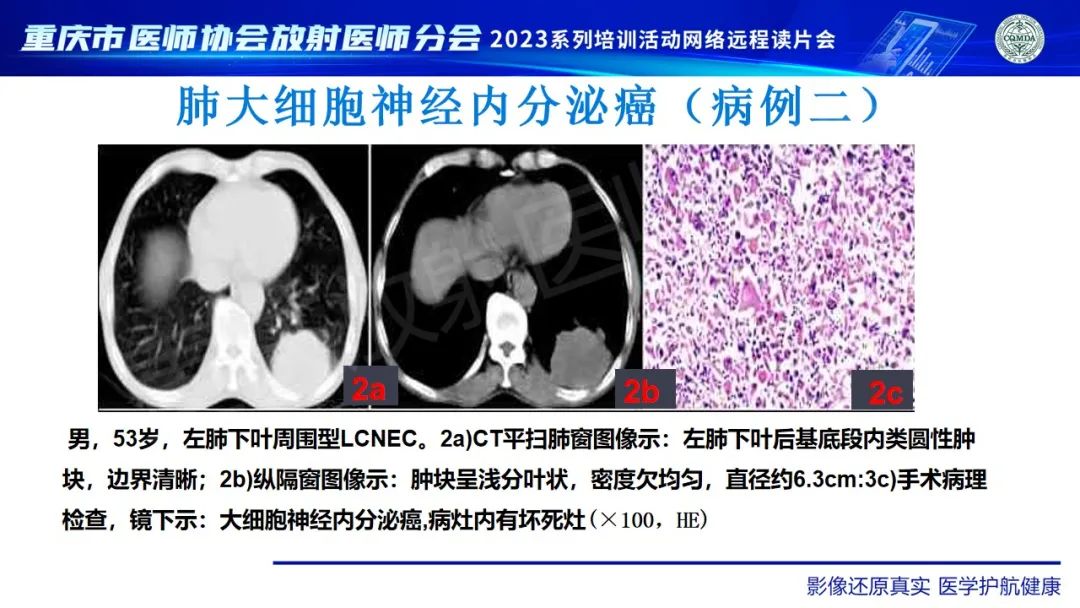 影像PPT - 【病例】肺大细胞神经内分泌癌1例CT影像-27