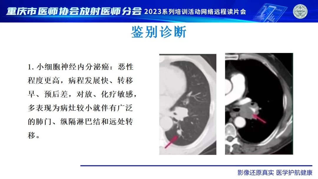 影像PPT - 【病例】肺大细胞神经内分泌癌1例CT影像-29