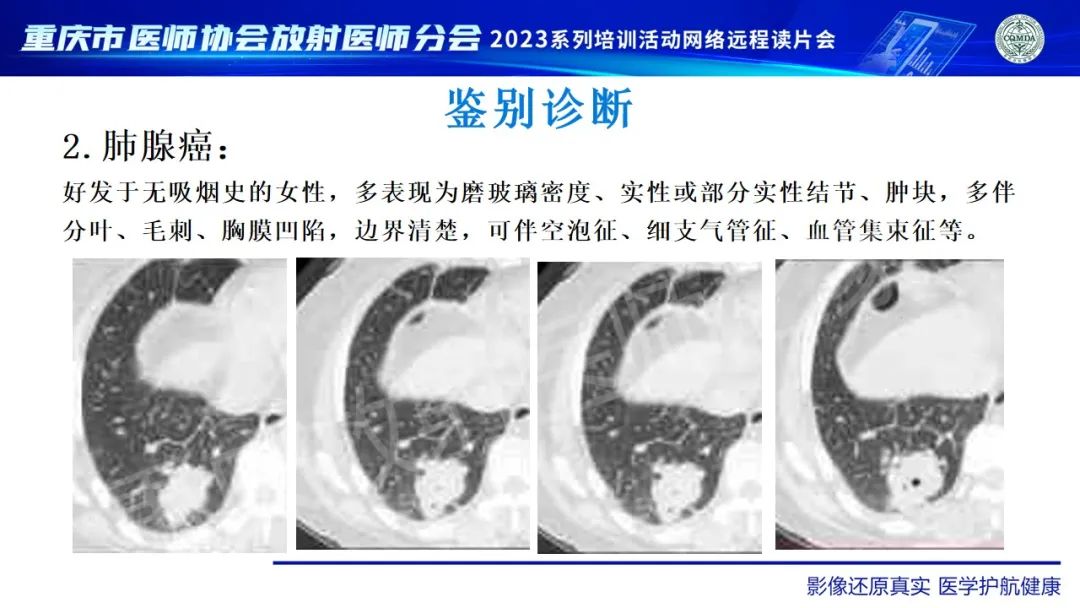 影像PPT - 【病例】肺大细胞神经内分泌癌1例CT影像-30