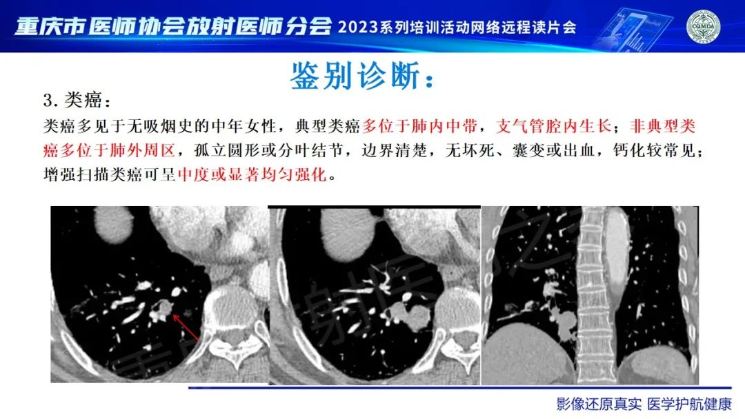 影像PPT - 【病例】肺大细胞神经内分泌癌1例CT影像-31