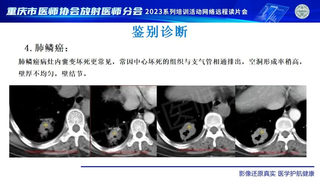 影像PPT - 【病例】肺大细胞神经内分泌癌1例CT影像-32