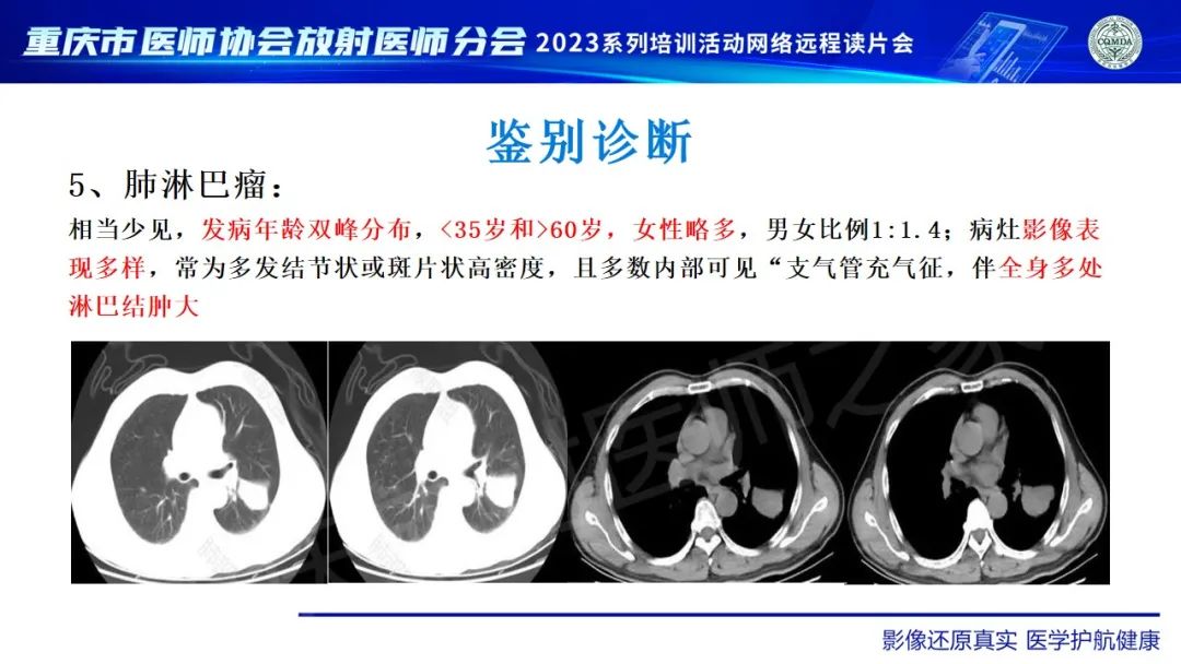 影像PPT - 【病例】肺大细胞神经内分泌癌1例CT影像-33