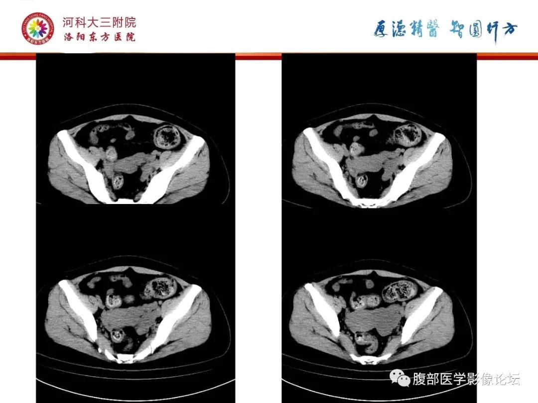 影像PPT - 【病例】静脉内平滑肌瘤病1例CT及MR影像-5