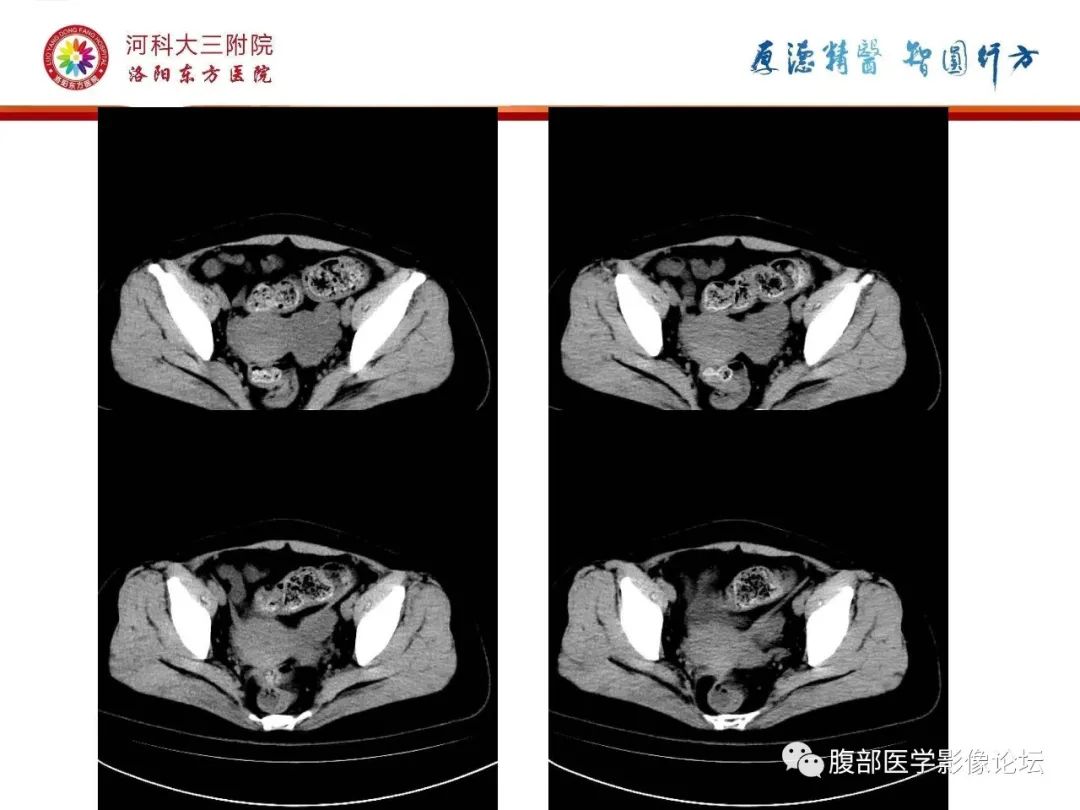 影像PPT - 【病例】静脉内平滑肌瘤病1例CT及MR影像-6