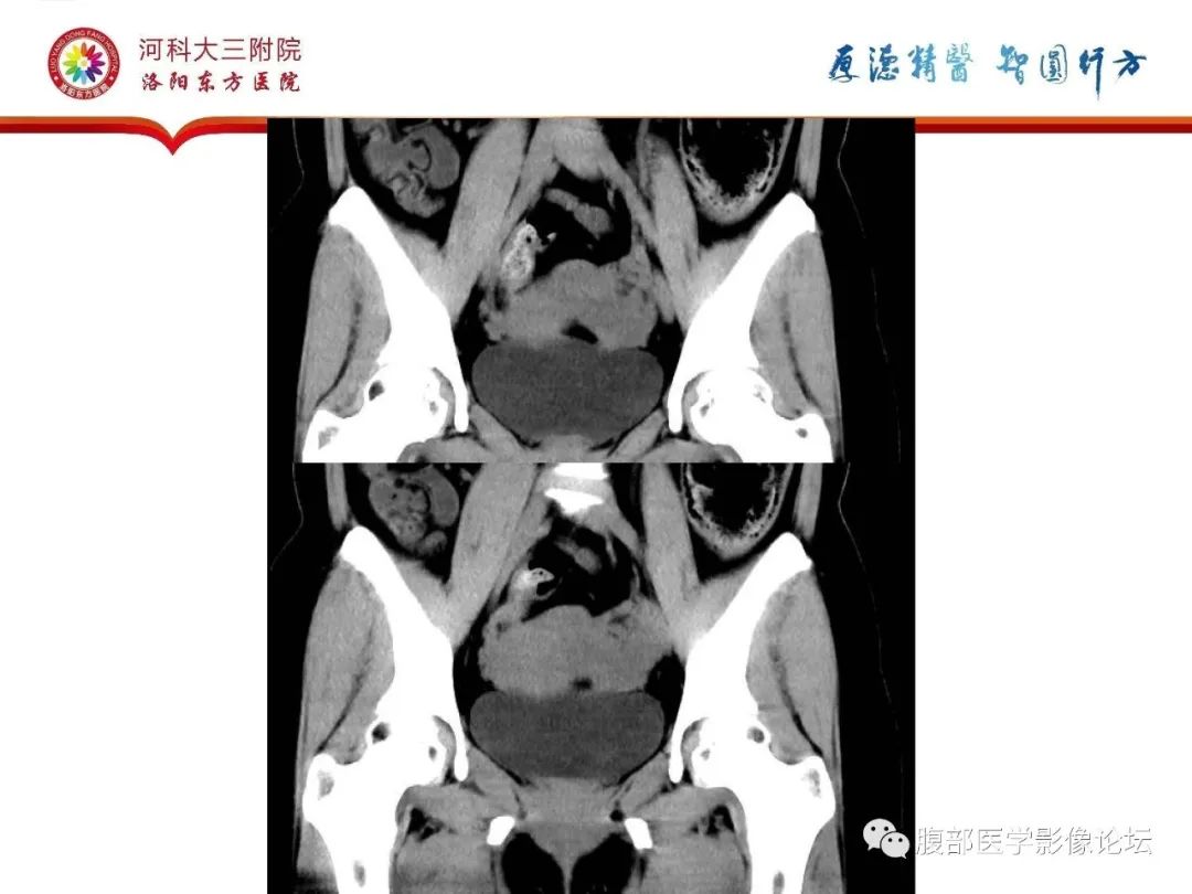 影像PPT - 【病例】静脉内平滑肌瘤病1例CT及MR影像-7