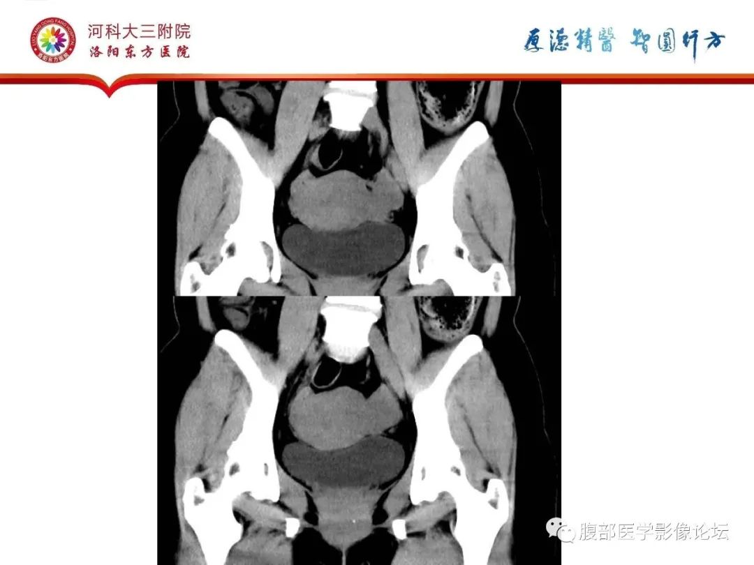 影像PPT - 【病例】静脉内平滑肌瘤病1例CT及MR影像-8