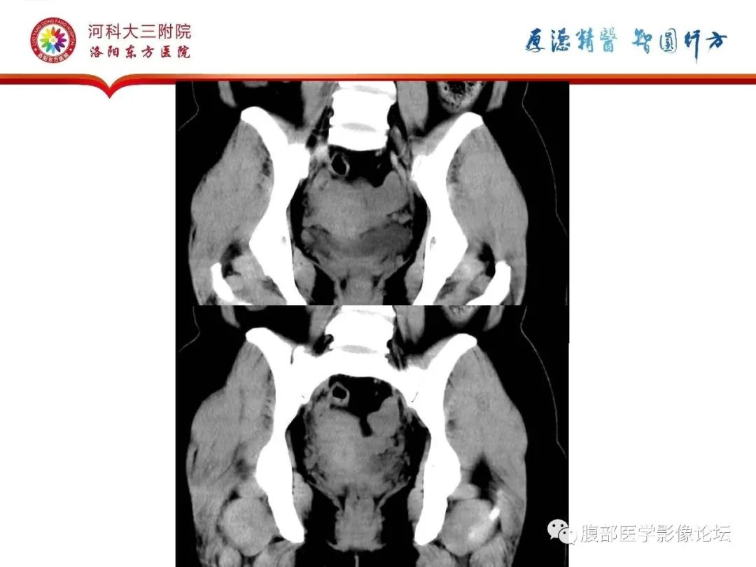 影像PPT - 【病例】静脉内平滑肌瘤病1例CT及MR影像-9