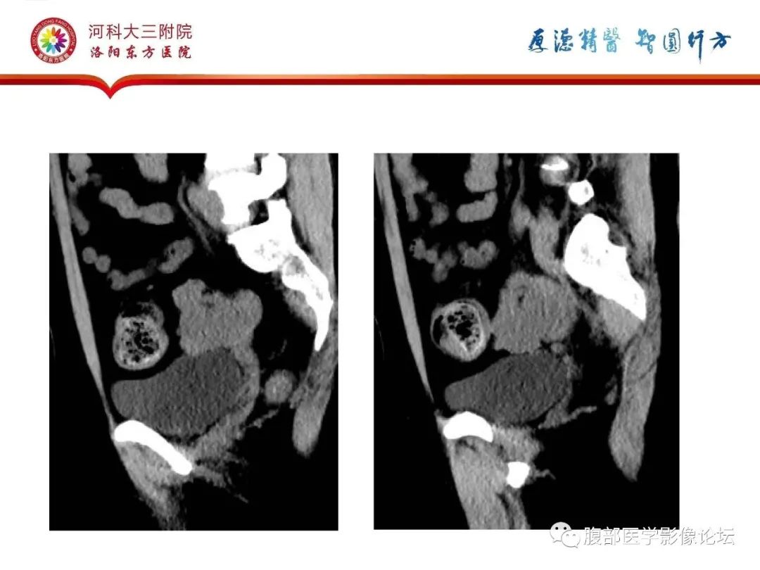 影像PPT - 【病例】静脉内平滑肌瘤病1例CT及MR影像-10