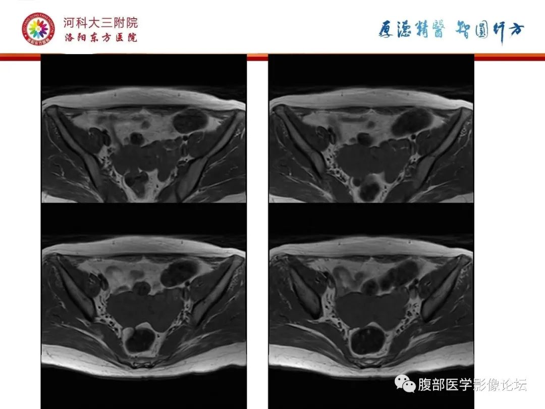 影像PPT - 【病例】静脉内平滑肌瘤病1例CT及MR影像-11