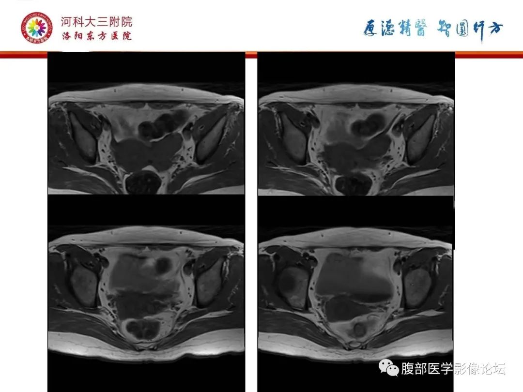 影像PPT - 【病例】静脉内平滑肌瘤病1例CT及MR影像-12