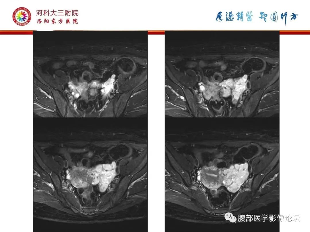 影像PPT - 【病例】静脉内平滑肌瘤病1例CT及MR影像-13