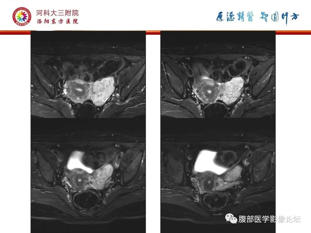 影像PPT - 【病例】静脉内平滑肌瘤病1例CT及MR影像-14