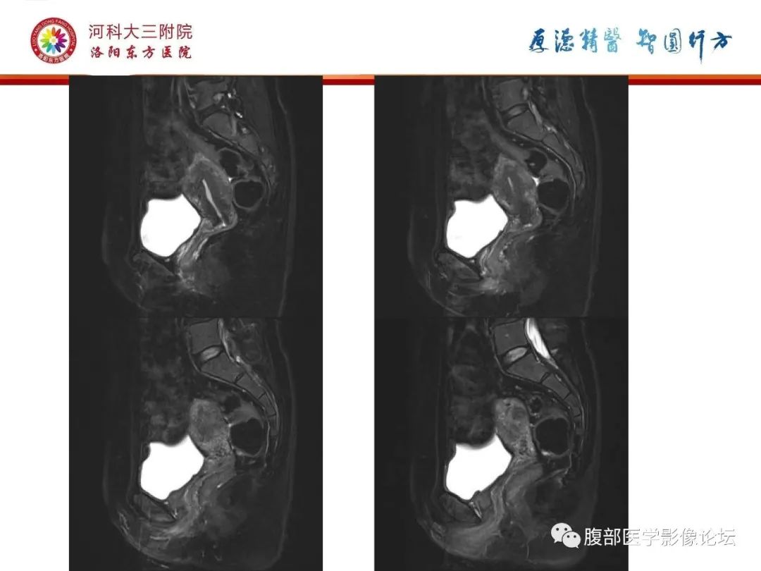 影像PPT - 【病例】静脉内平滑肌瘤病1例CT及MR影像-15