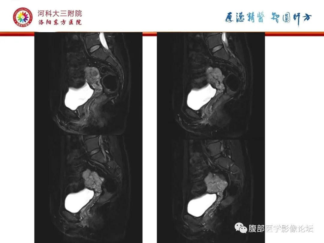 影像PPT - 【病例】静脉内平滑肌瘤病1例CT及MR影像-16