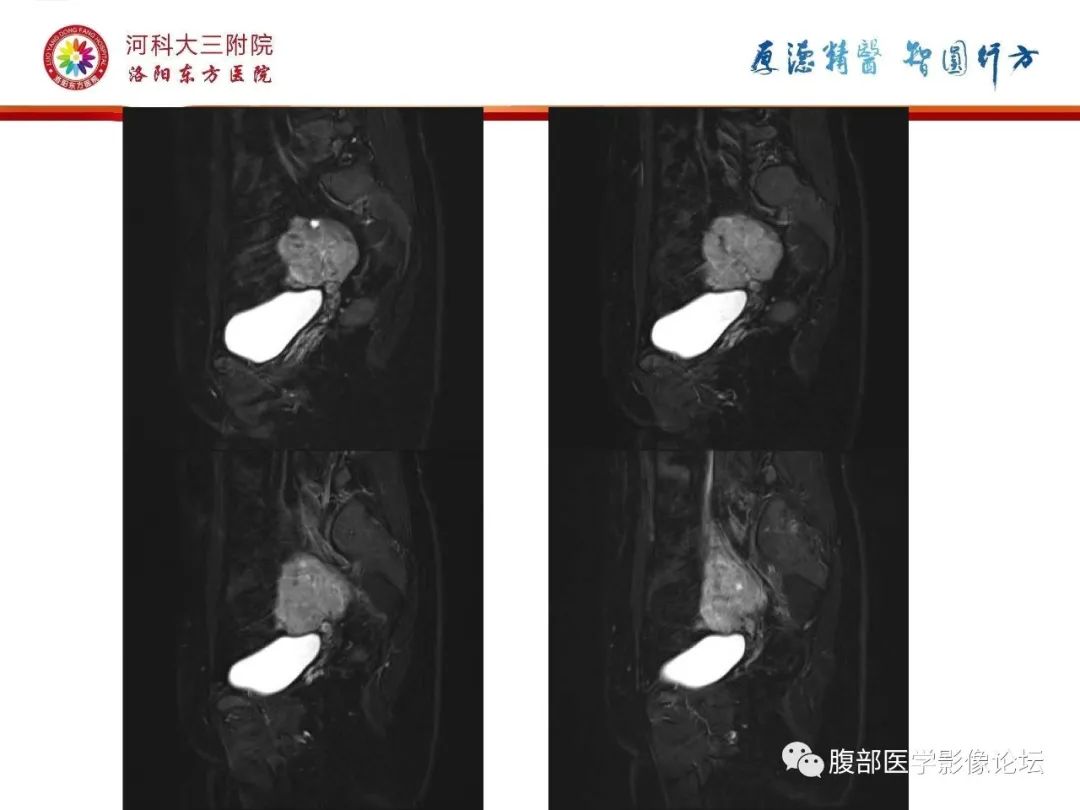 影像PPT - 【病例】静脉内平滑肌瘤病1例CT及MR影像-17