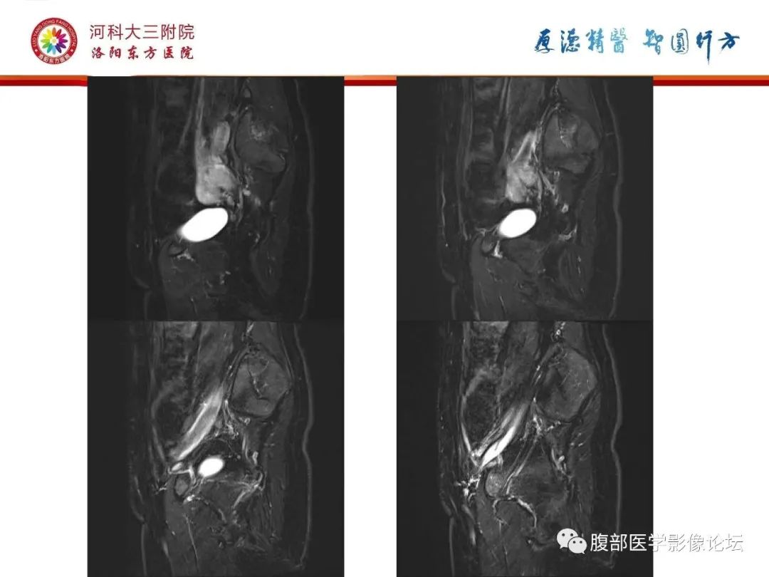 影像PPT - 【病例】静脉内平滑肌瘤病1例CT及MR影像-18