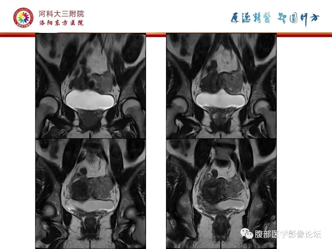 影像PPT - 【病例】静脉内平滑肌瘤病1例CT及MR影像-19